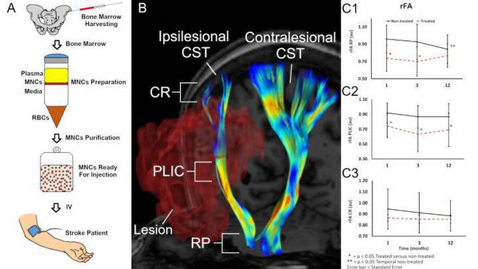 Study Provides Evidence That Bone Marrow Cell Injections Help Heal the Brain After Stroke