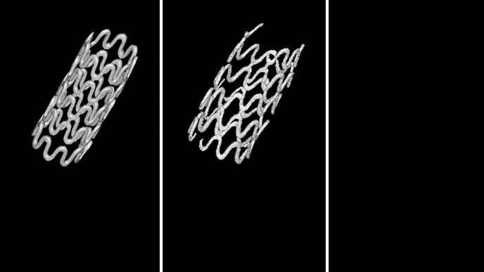 Breathing Easier with a Better Tracheal Stent