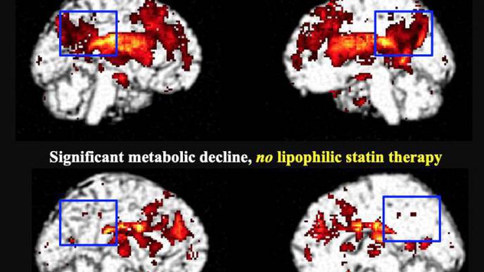 FDG-PET Shows Lipophilic Statin Users at Higher Risk of Dementia