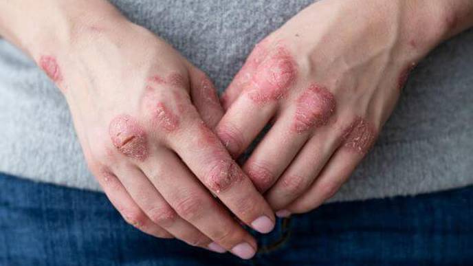Overall Pregnancy, Live Birth Outcomes Unchanged in Psoriasis