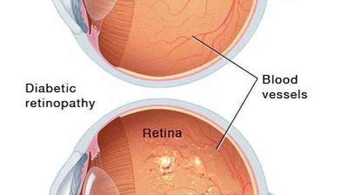 A Healthy Lifestyle for Cardiovascular Health Also Promotes Good Eye Health