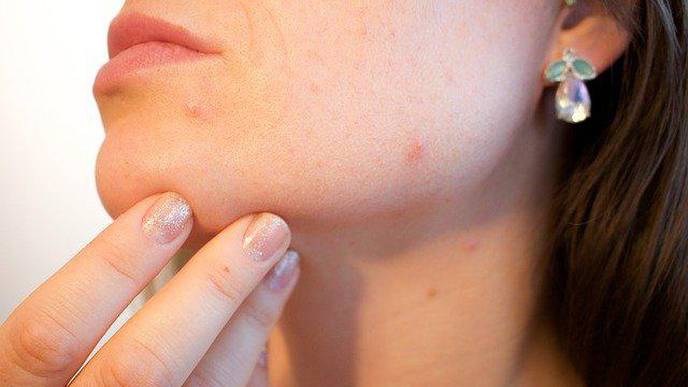 Chemical Reconstruction Plus Fractionated Nonablative Laser Improves Appearance of Acne Scars
