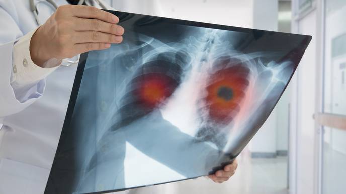 The Serious Impact of COVID-19 on Lung Cancer