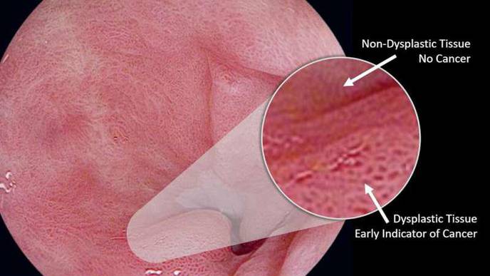 Detecting Oesophageal Cancer with AI