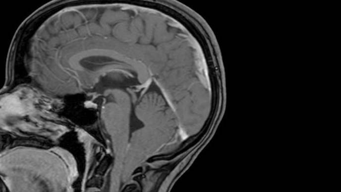 Common Brian Malformation Traced to Its Genetic Roots