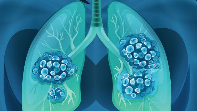 Could Lung Cancer Cases Be Mistaken for COVID-19?