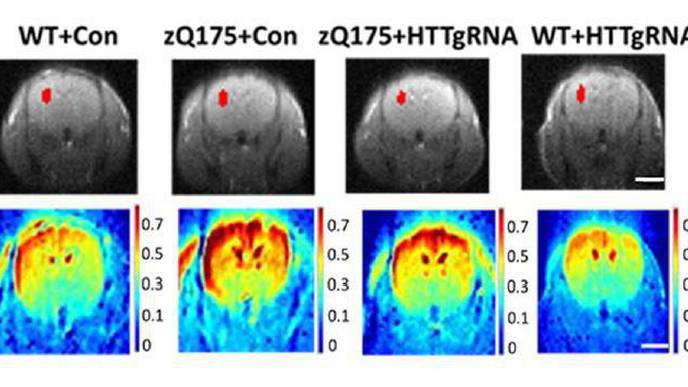 Gene Editing Therapy in Early Stages of Huntington’s Disease May Slow Down Symptom Progression, Mouse Study Shows