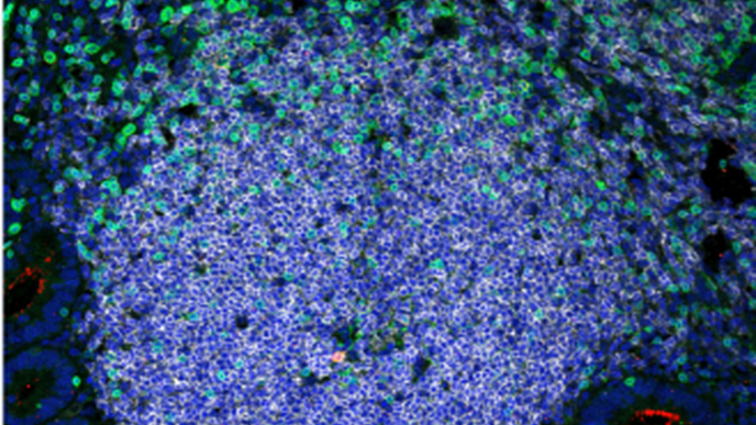 Research Provides a Roadmap to HIV Eradication Via Stem Cell Therapy