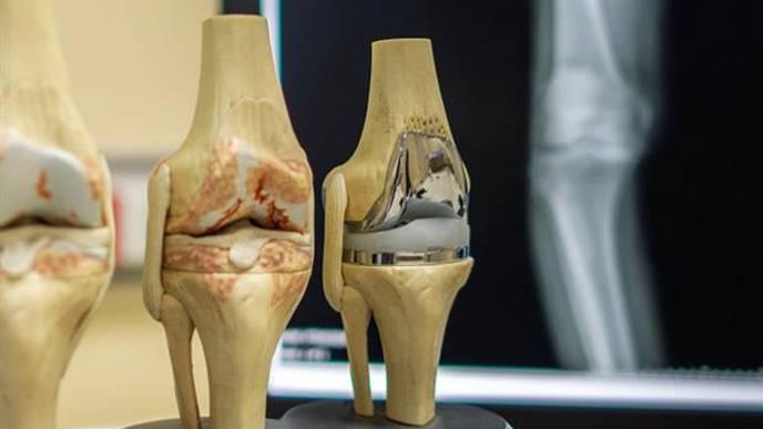 Personalized 3D Printed Knee Implant Could Bring Relief to Thousands of Arthritis Sufferers