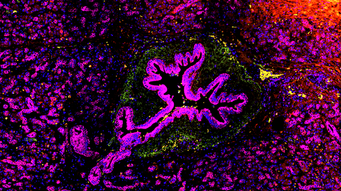 New Insights on How Inflammatory Molecule Contributes to Skin & Pancreatic Cancers