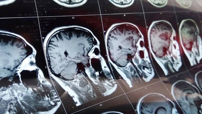 Stroke Patients with COVID-19 Have Increased Systemic Inflammation