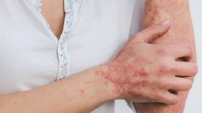 Herpes, Hair Fall, Nail Issues: Doctors Caution on Post-COVID Dermatological Problems