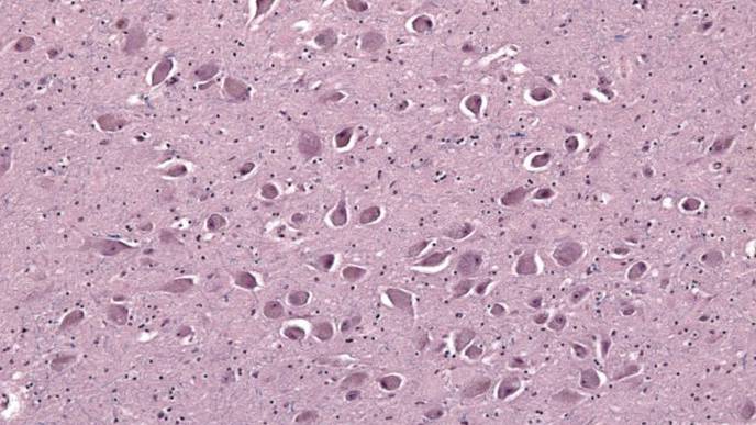 CTE Linked to REM Sleep Behavior Disorder