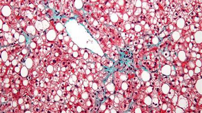 Novel Antisense Drug Shows Promise in Slowing Fatty Liver Disease