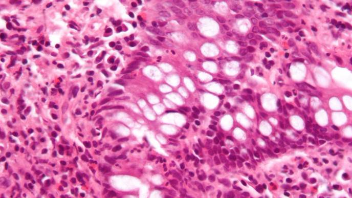 Can Diet Help with Inflammatory Bowel Disease?