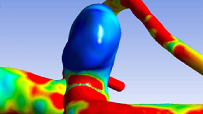Researchers Find 17 Genetic Abnormalities That Cause Brain Aneurysms