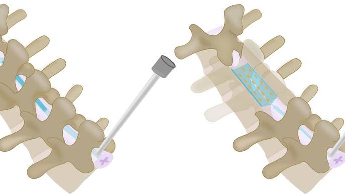 Inflatable, Shape-Changing Spinal Implants Could Help Treat Severe Pain