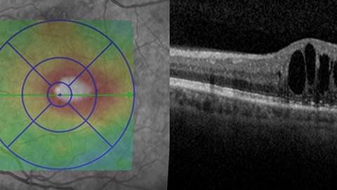 Frontiers in Diabetic Macular Edema: Increasing Durability to Improve Vision Outcomes in Vulnerable Populations