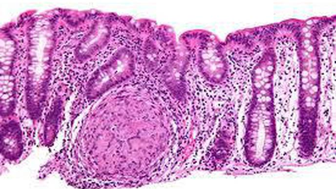 Researchers Identify Genomic & Immune Indicators That Predict Lethal Outcomes in Prostate Cancer