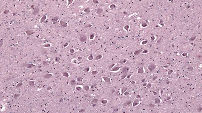 CTE Linked to REM Sleep Behavior Disorder