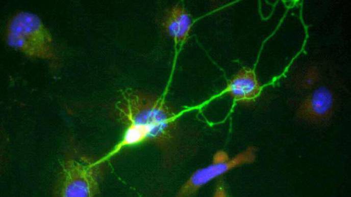 Bourneville's Tuberous Sclerosis: Everything Unfolds in the Brain Shortly After Birth