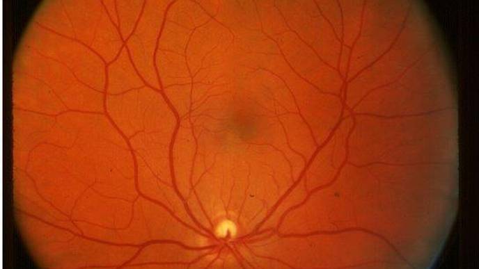 Routine Eye Scans May Give Clues to Cognitive Decline in Diabetes