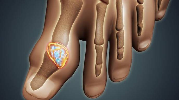 Gout Cases Are Rising Worldwide