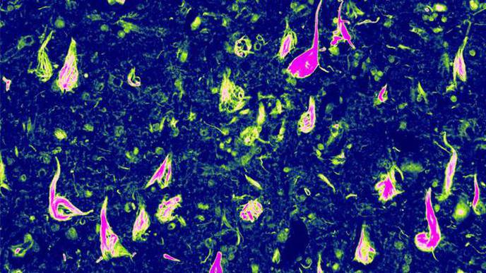 Protein Changes Could Act as ALS Biomarker