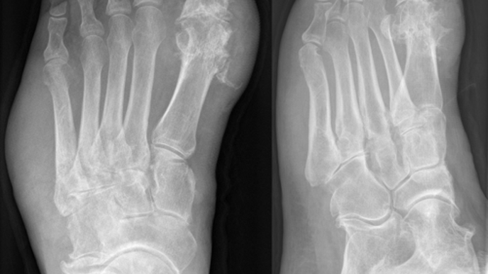 Amputations of Body Parts: Combination of Diabetes & Gout Significantly Increases Risk