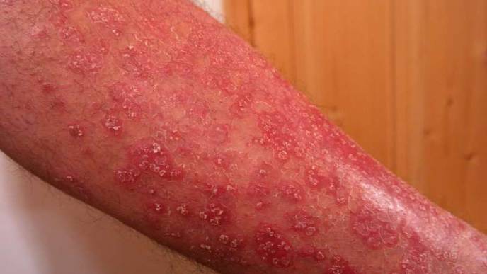 Single Gene Biomarker Identified to Differentiate Between Atopic Dermatitis and Psoriasis