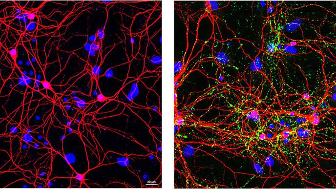 ‘Natural Killer’ White Blood Cells Could Guard Against Parkinson’s Progression
