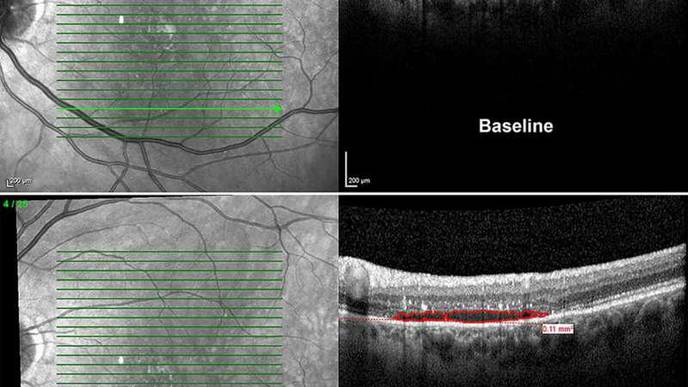 Levodopa May Improve Vision in Patients with Macular Degeneration