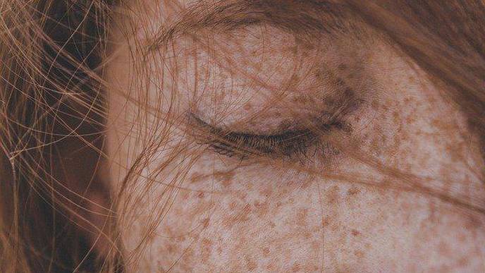 Facial Pigmentation Impacts Quality of Life Regardless of Clinical Severity