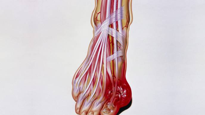Patients With vs Without Gout May Be at Increased Risk for Epilepsy