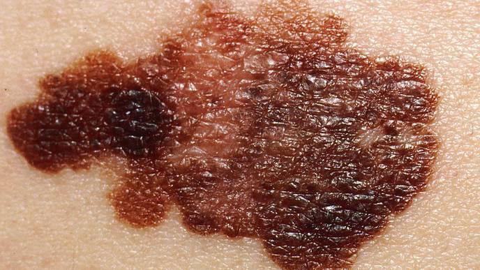 Immunotherapy Spin-Out Tests New Personalized Therapy for Melanoma