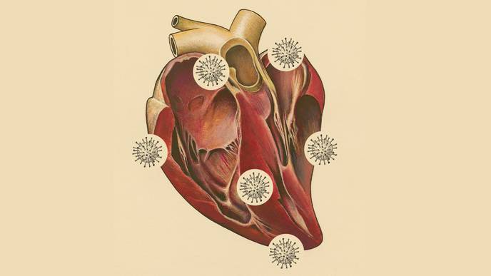What Do These Autopsies Reveal About COVID-19 & Heart Damage?