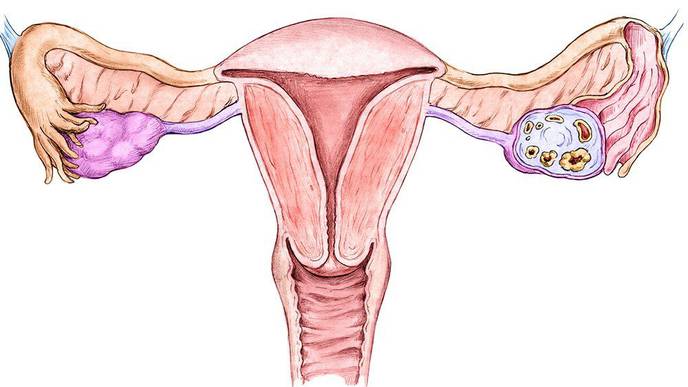 Obesity Increases Endometrial Cancer Risk