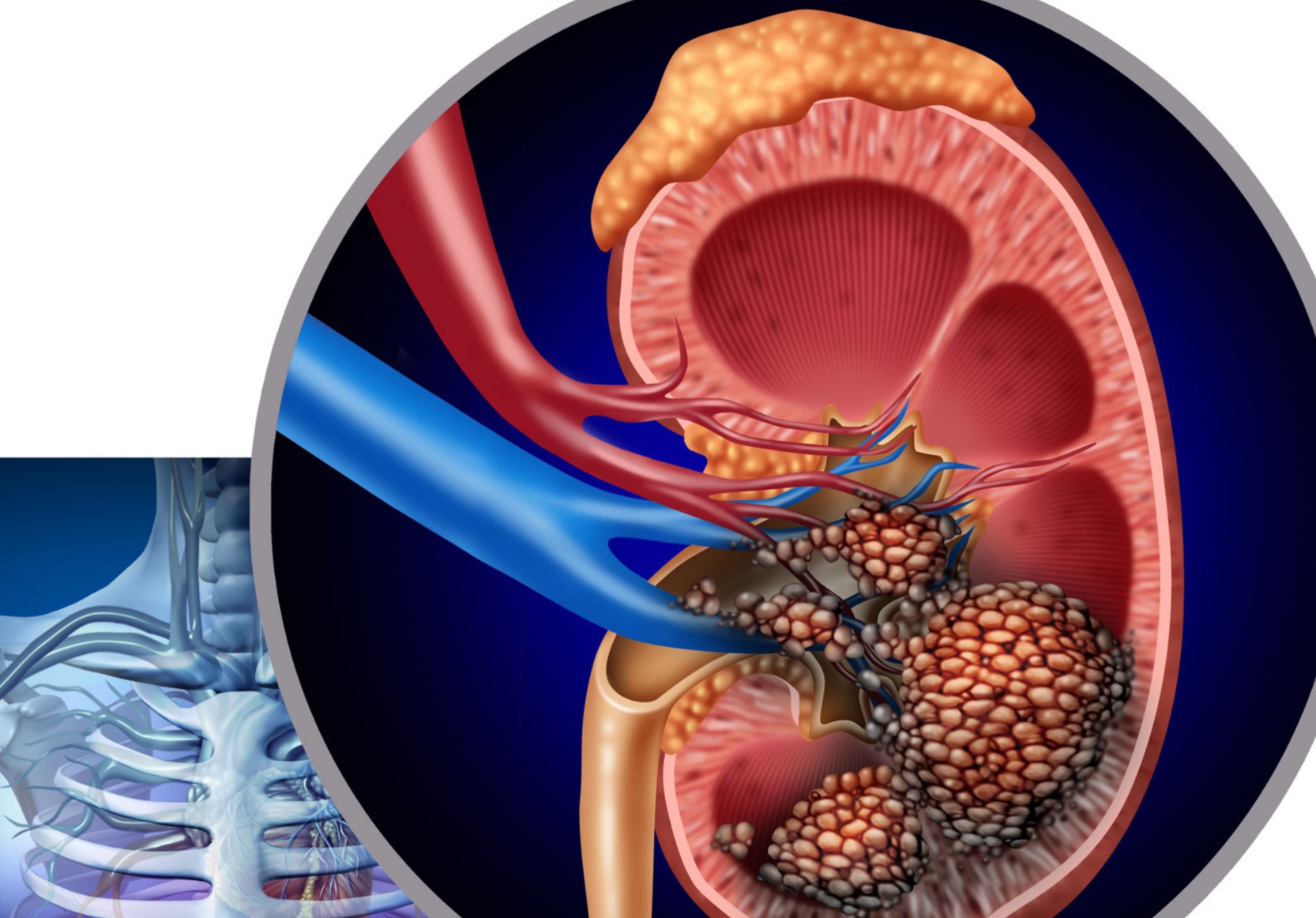 Novel PET-CT Imaging Method Enhances Early Detection of Aggressive ...